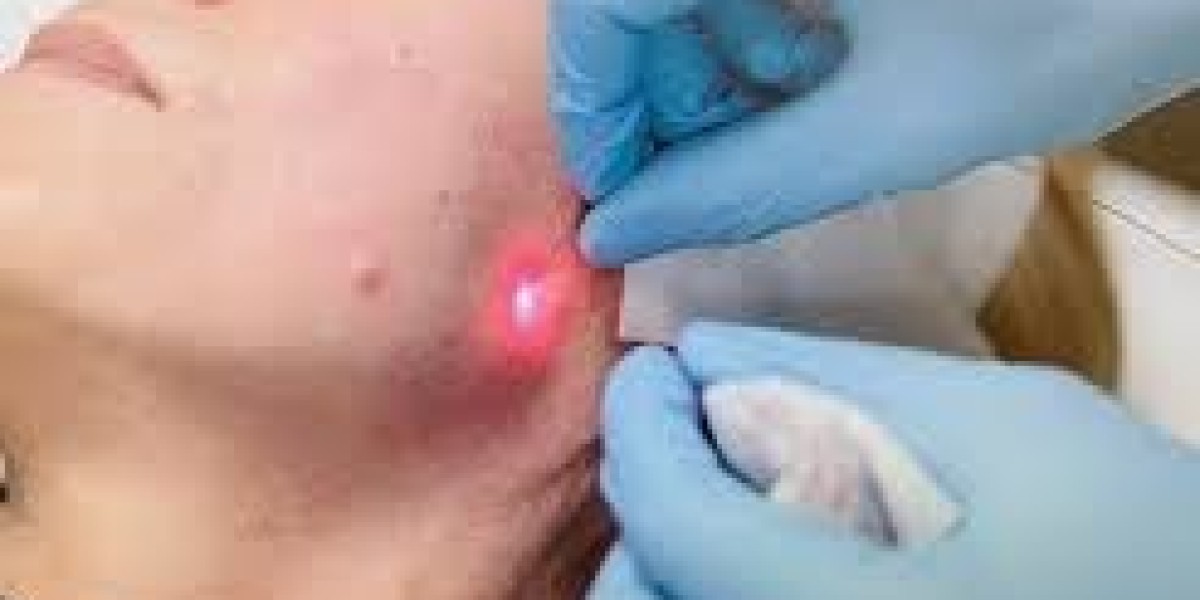 The Growing Popularity of Endolift Treatment in Dubai for Facial Rejuvenation