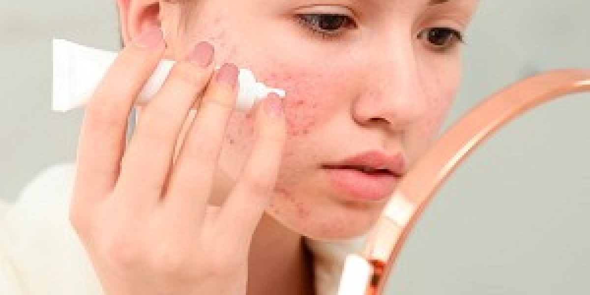 Pimples Treatment in Dubai: Physician-Led Acne Solutions