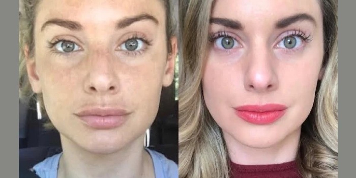 Best Aesthetic Clinic in Dubai for Radiofrequency (RF) Microneedling: Aftercare Tips