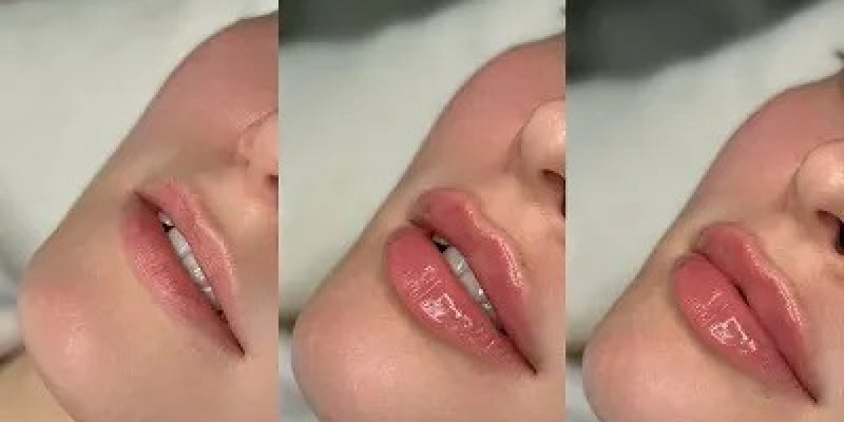 Lip Augmentation for Soft and Natural Lips at Glam Clinic Islamabad