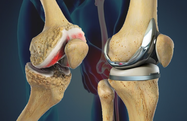 Knee Surgery Treatment  in Abu Dhabi