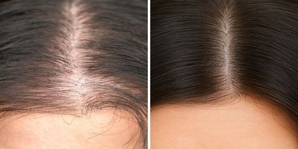Achieve Thick Hair with a Premium Hair Transplant in Dubai