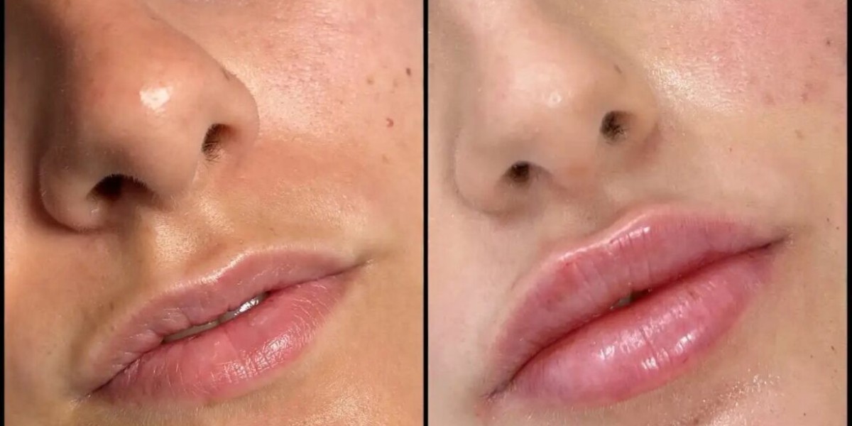 Fillers Treatments in Dubai for Long-Lasting Facial Beauty