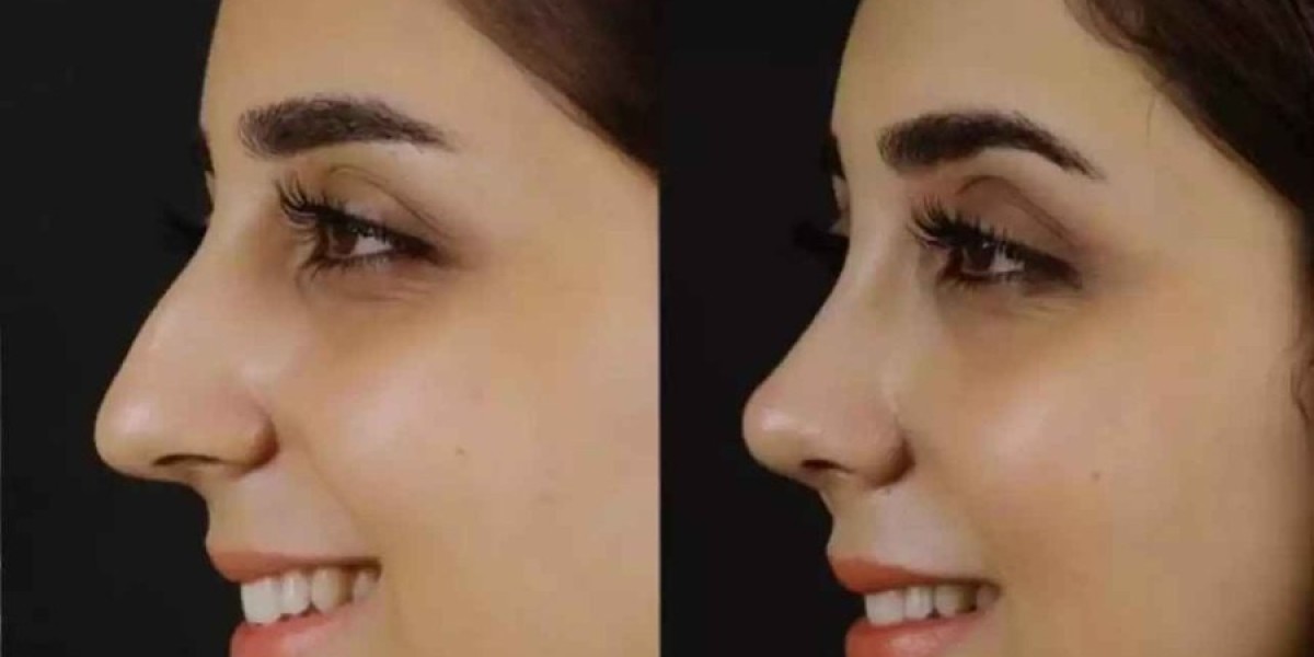 Best Doctors in Dubai Highlight Septoplasty Advantages