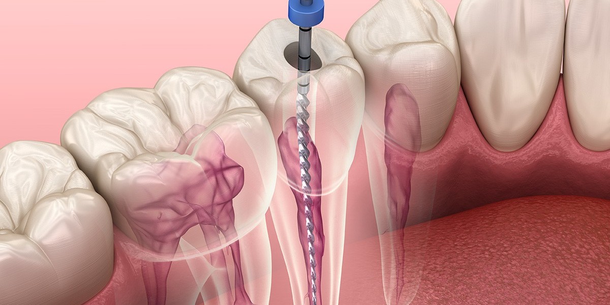 Root Canal Treatment in Islamabad: Everything About Diagnosis and Treatment