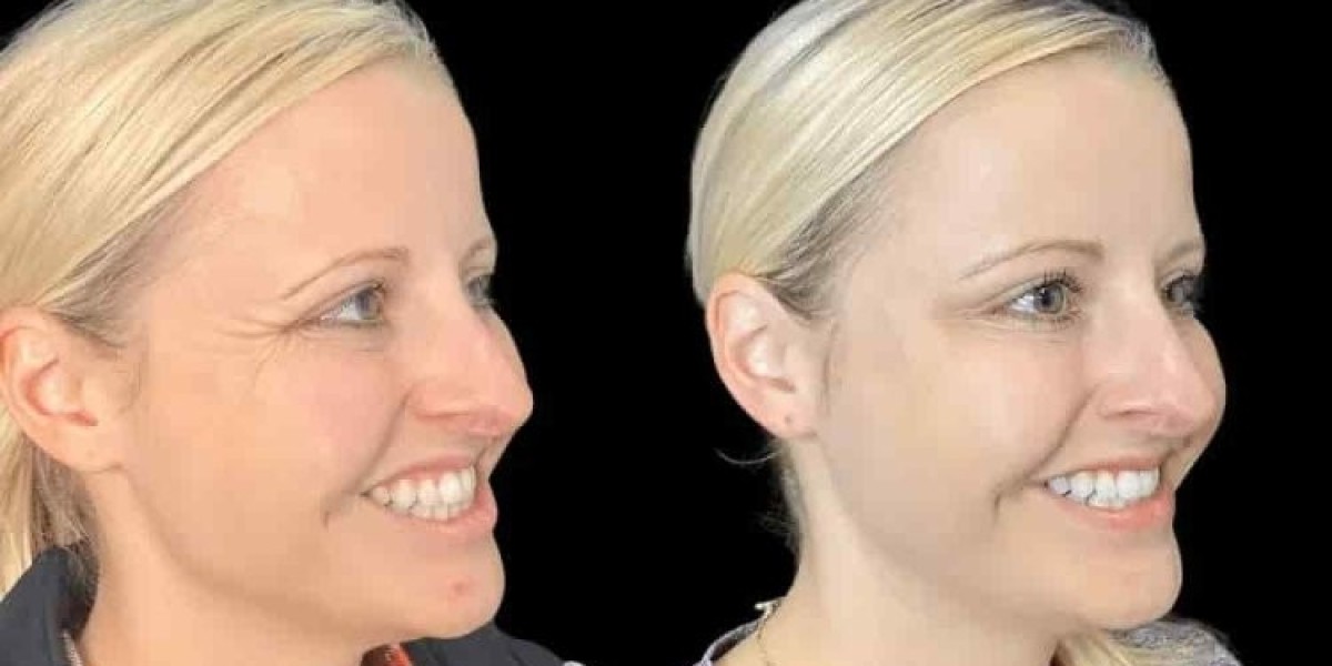 Best Doctors in Dubai for Botox for Facial Anti-Aging Treatments