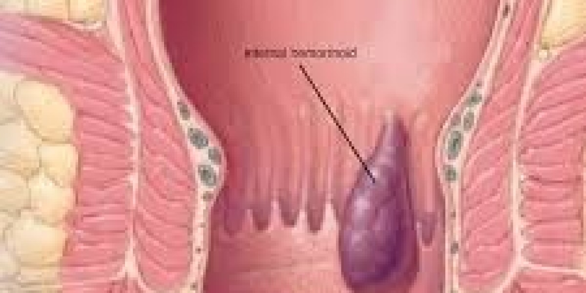 Benefits of Choosing Haemorrhoids Treatment in Dubai | Complete Guide to Better Health