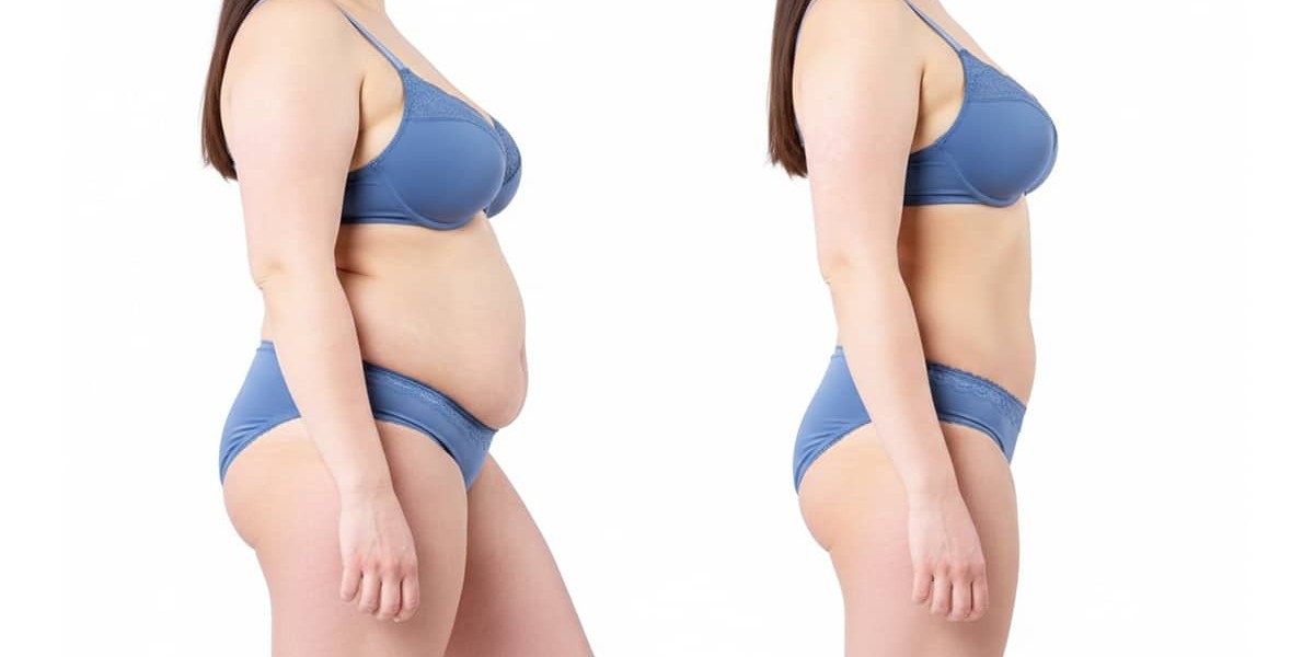 Mommy Makeover Dubai: Restore Your Body Confidence