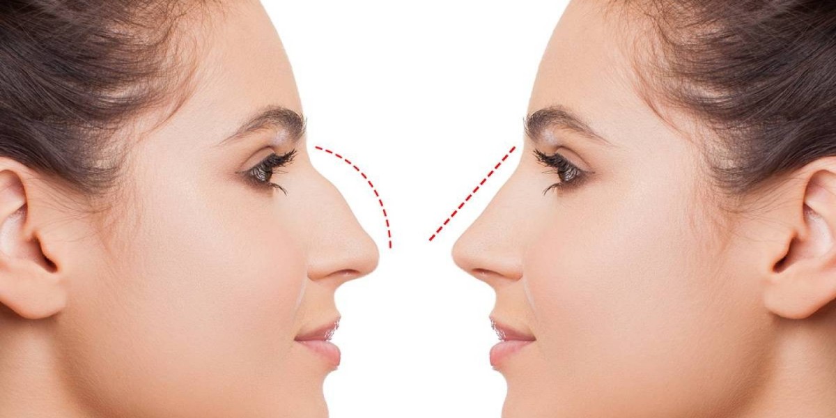 Rhinoplasty and Confidence in Public Appearance