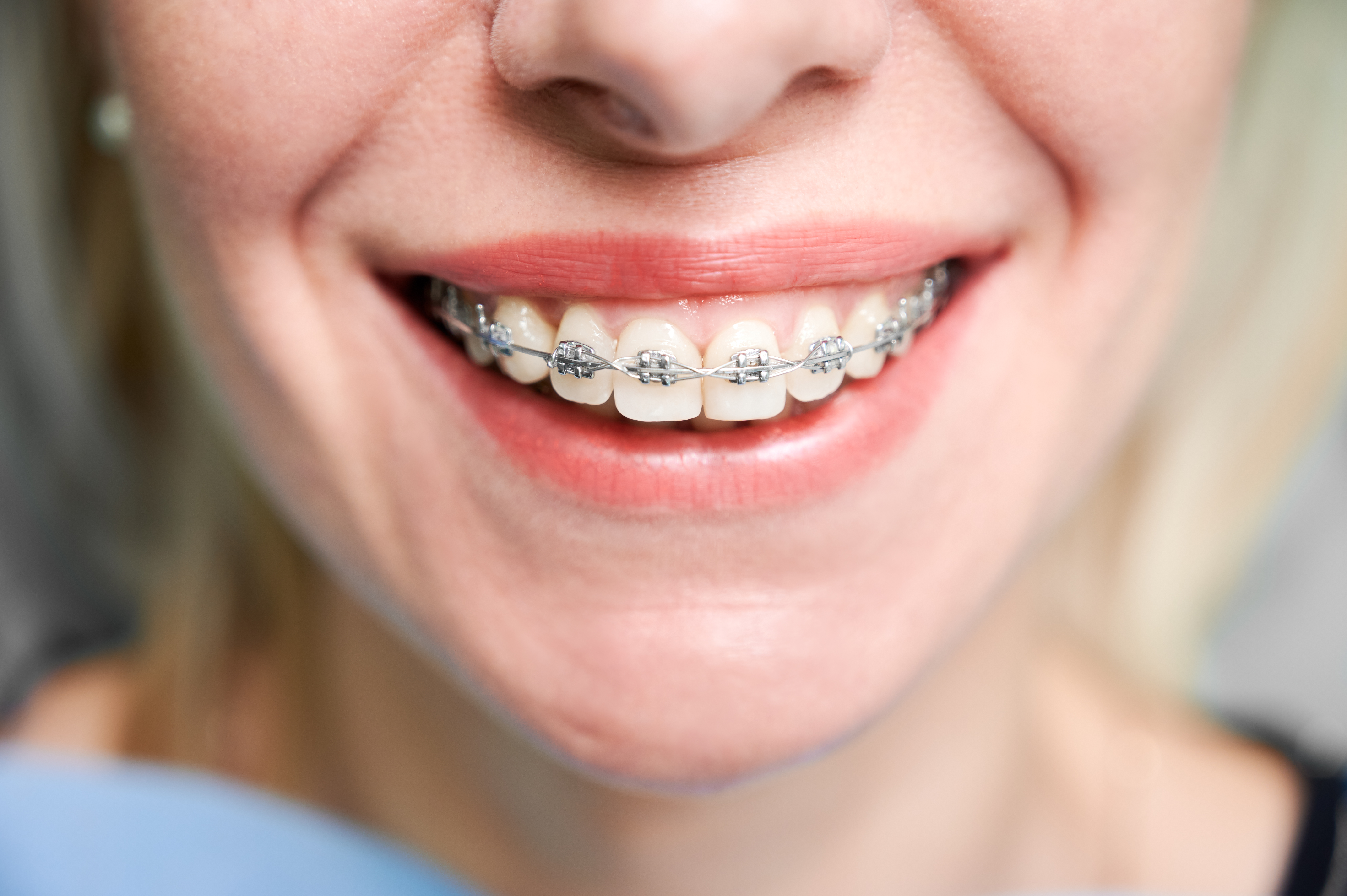 Clear Aligners in Camden: A Modern Path to a Confident Smile – parkroyalorthodontics