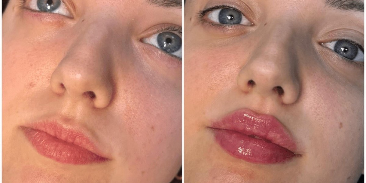 Personalized Treatment Plans With Juvederm in Dubai