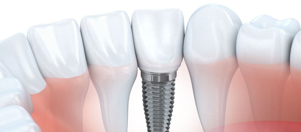 Bryn Mawr Implant Dentistry | Wayne Implant Dentistry | Dr. Amy Shoumer