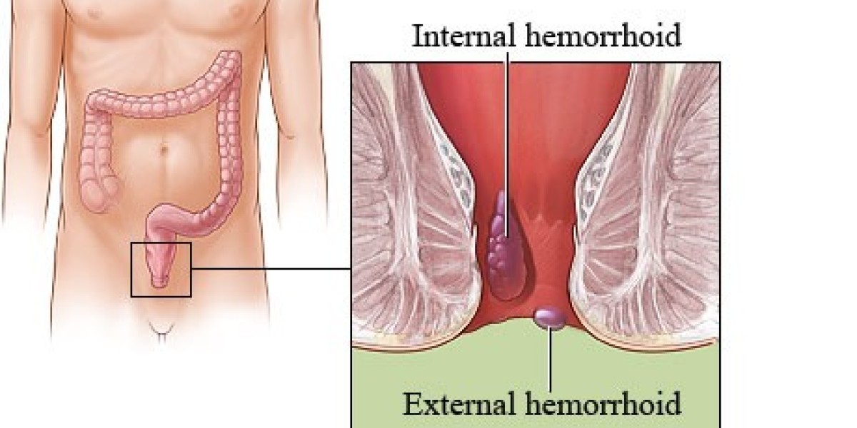 Why More People Choose Haemorrhoids Treatment in Dubai | Safe & Effective Solutions