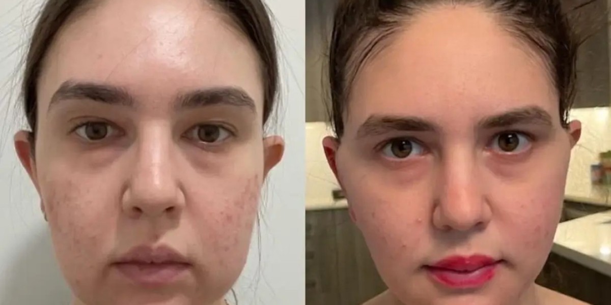 The Latest Techniques Used for Buccal fat removal in Dubai