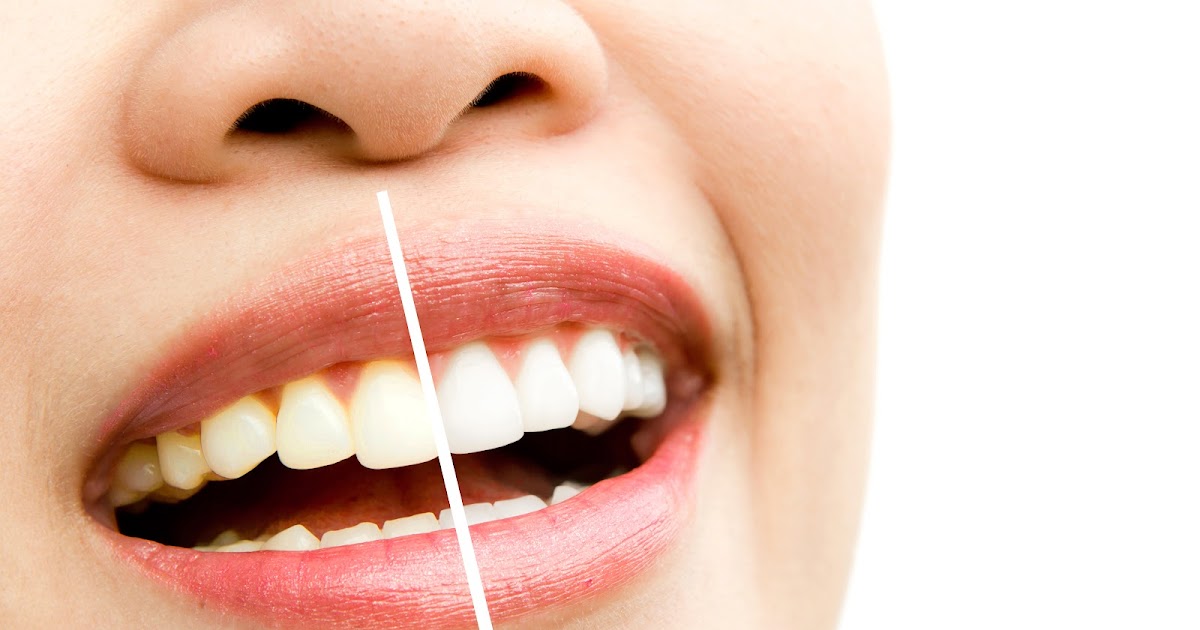 Where Can I Find Affordable Teeth Whitening in Middle Village?