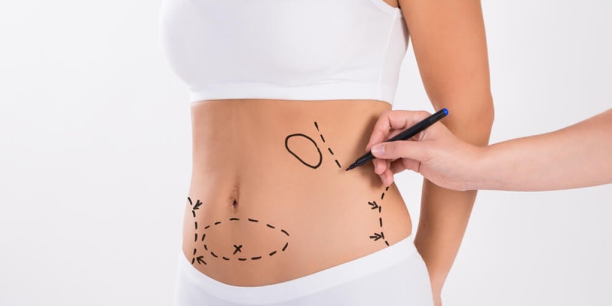 Best Liposuction Doctors in Dubai Share Proven Tips