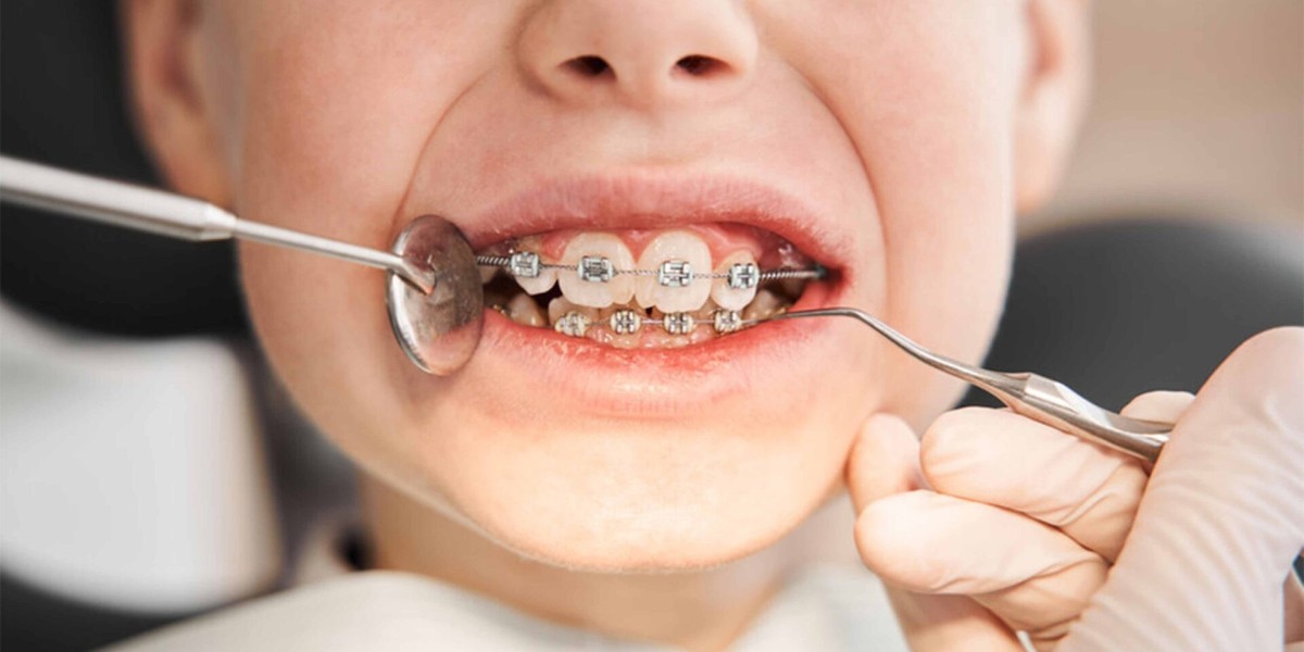 Braces Cost in Pakistan: Everything Pakistani Families Should Consider Before Treatment