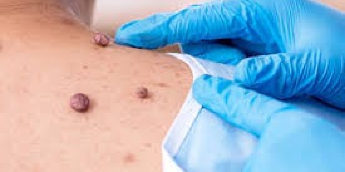 Mole Removal in Dubai: Advanced Treatments for Unwanted Skin Growths