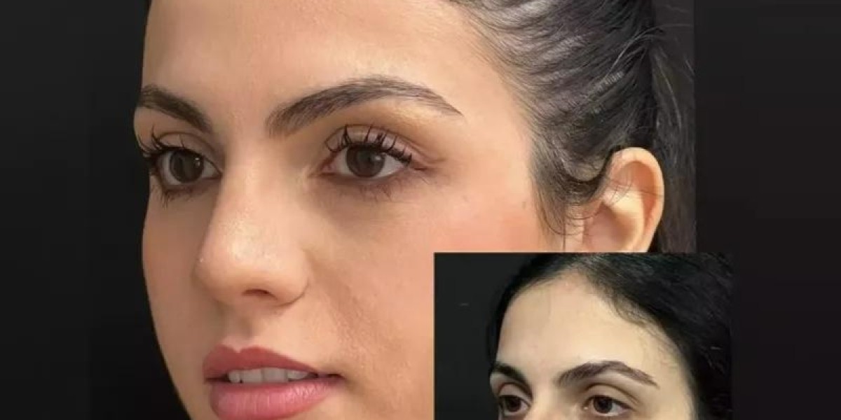 Rhinoplasty Surgery in Dubai for a Balanced Facial Look