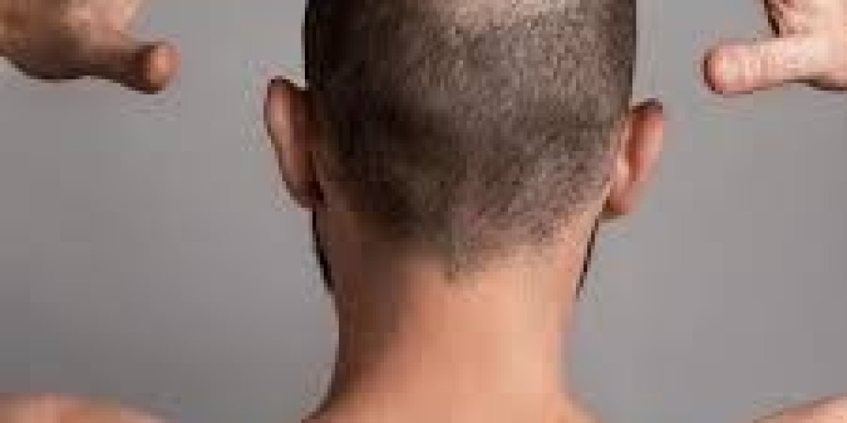 The Science Behind Hair Transplant in Dubai | Complete Hair Restoration Guide