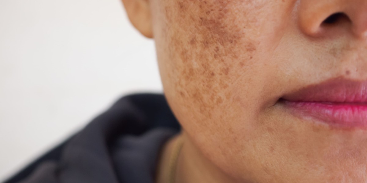 Skin Pigmentation in Dubai: Complete Treatment Guide