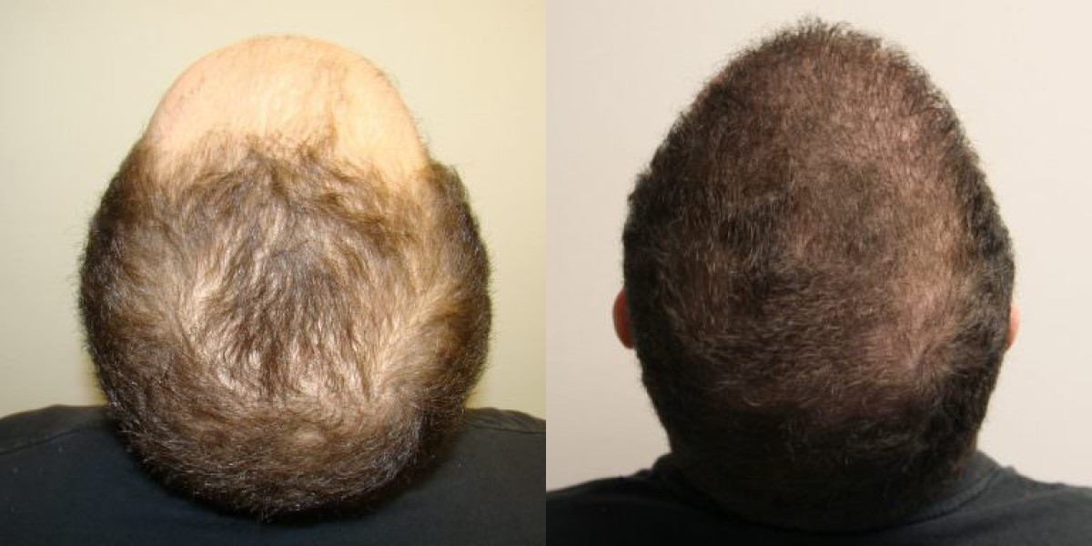 Hair Transplant in Dubai: Comprehensive Surgical Excellence
