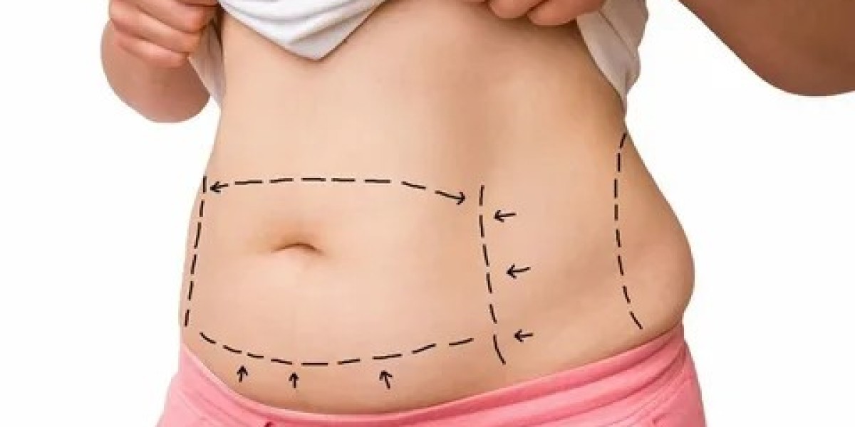 Tummy Tuck in Dubai: Definitive Guide