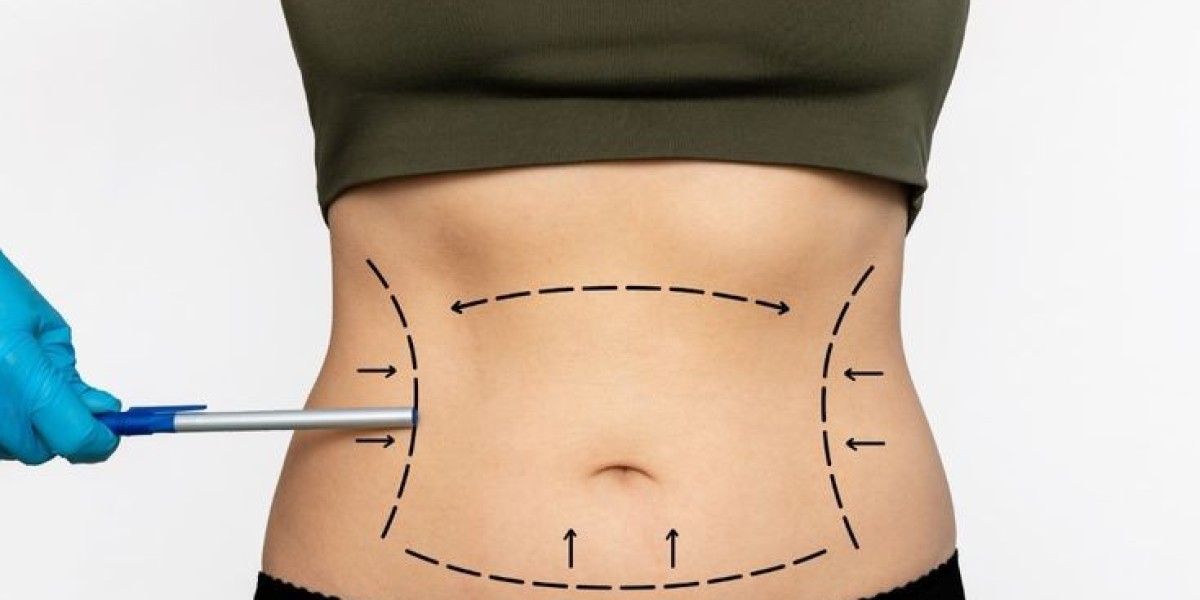 Tummy Tuck in Dubai: Safe Abdominal Recontouring