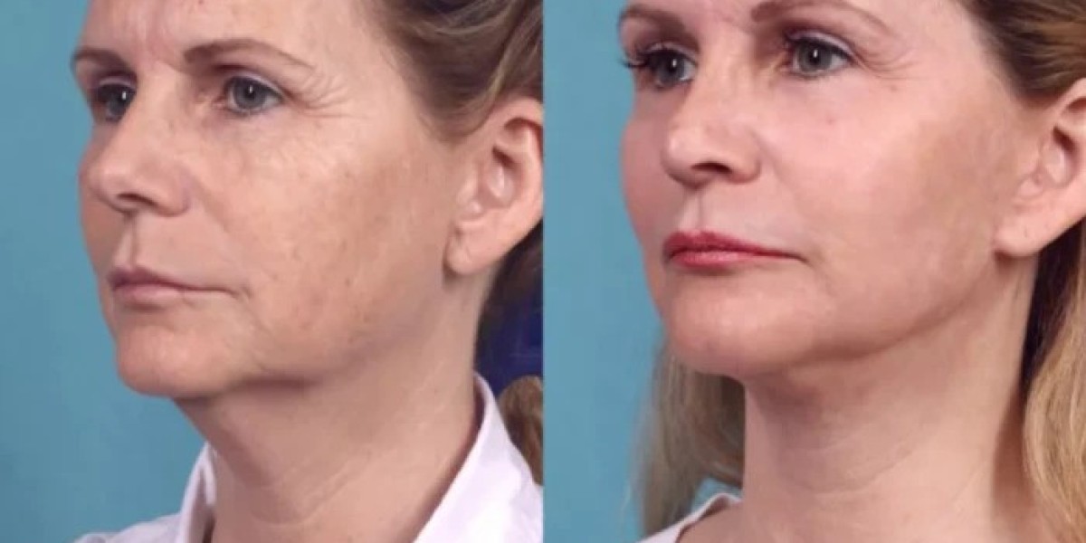 Understanding Thread Lift with Best Doctors in dubai