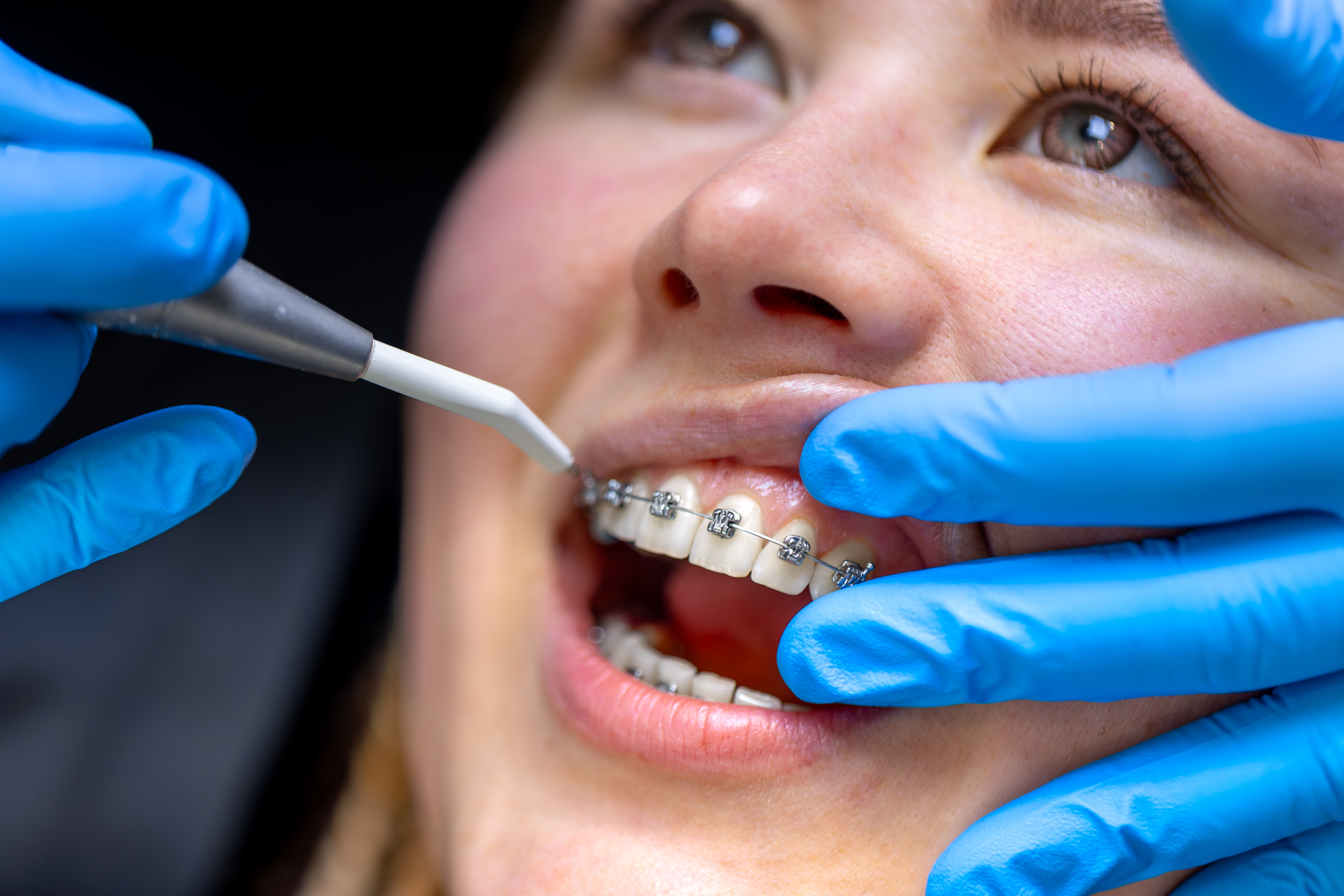 The Benefits of Opting for Braces in Highlands Ranch – unionorthodontics