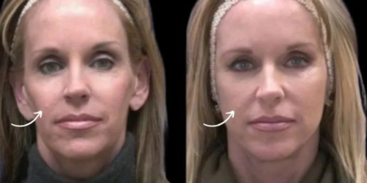 Sculptra Treatments in Dubai for Mid-Face Volume