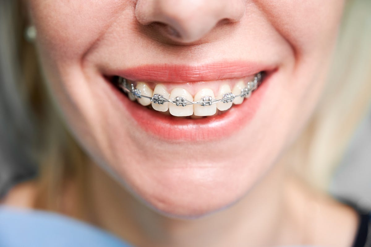 The Complete Guide to Portland in Braces: Treatment, Benefits, and Results | by Orthodontistsportland | Jul, 2026 | Medium