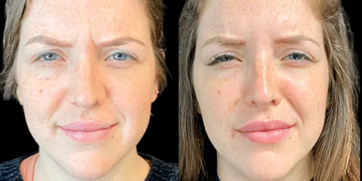 Can Botox Treatment in Dubai Prevent Future Wrinkles?