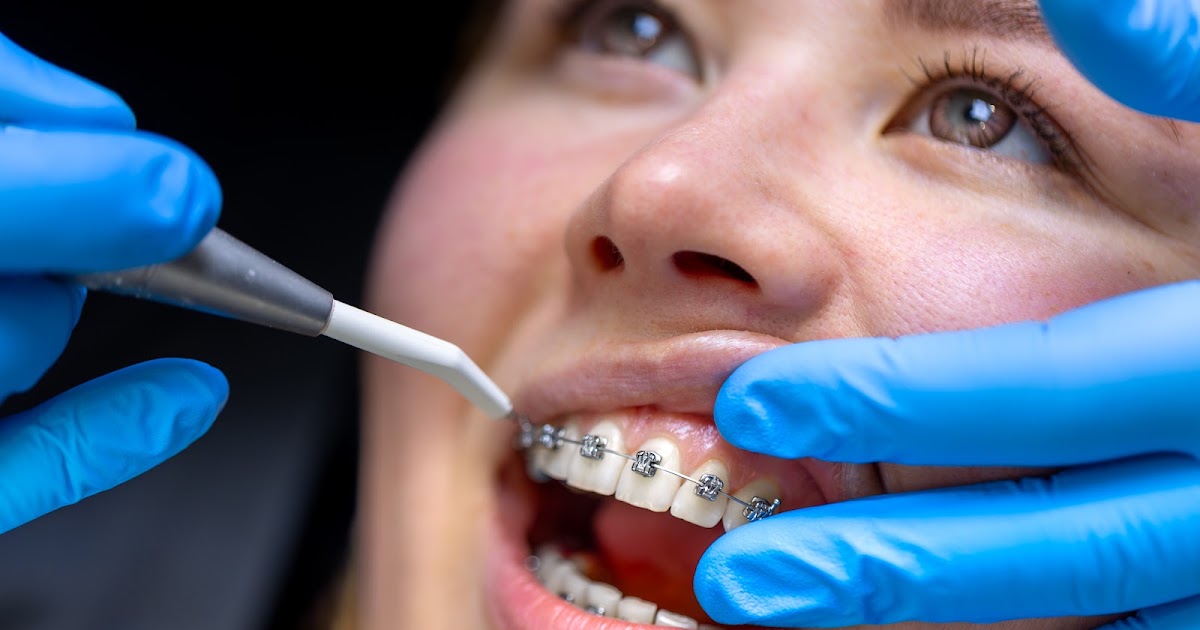 Why Braces in Marin County Are a Better Investment for a Healthy Smile