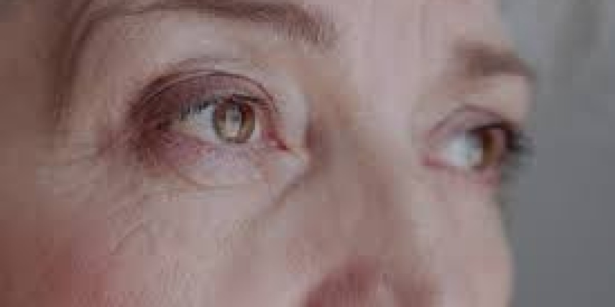 Fine Lines and Wrinkles in Dubai: Causes, Prevention, and Treatment Options