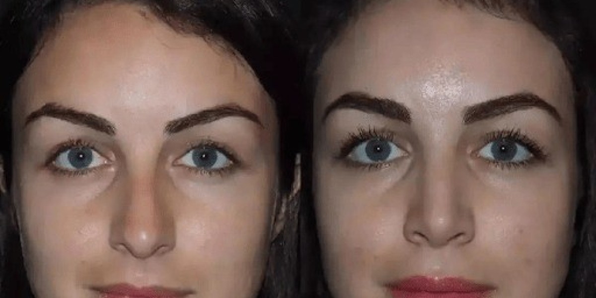 How the Best Rhinoplasty Surgeon in Dubai Enhances Facial Harmony