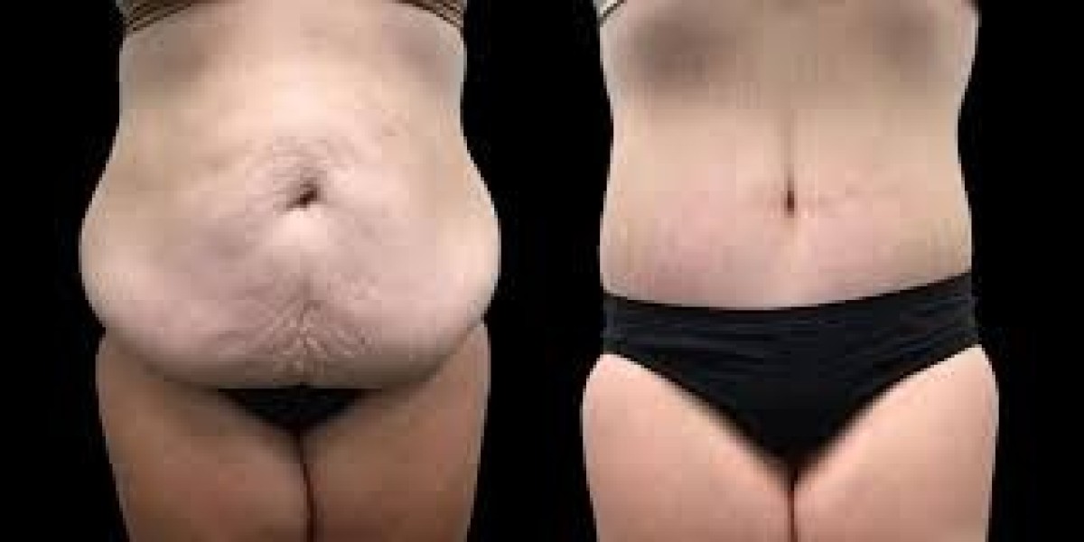 How Post-Weight Loss Surgery in Dubai Can Transform Loose Skin | Complete Guide