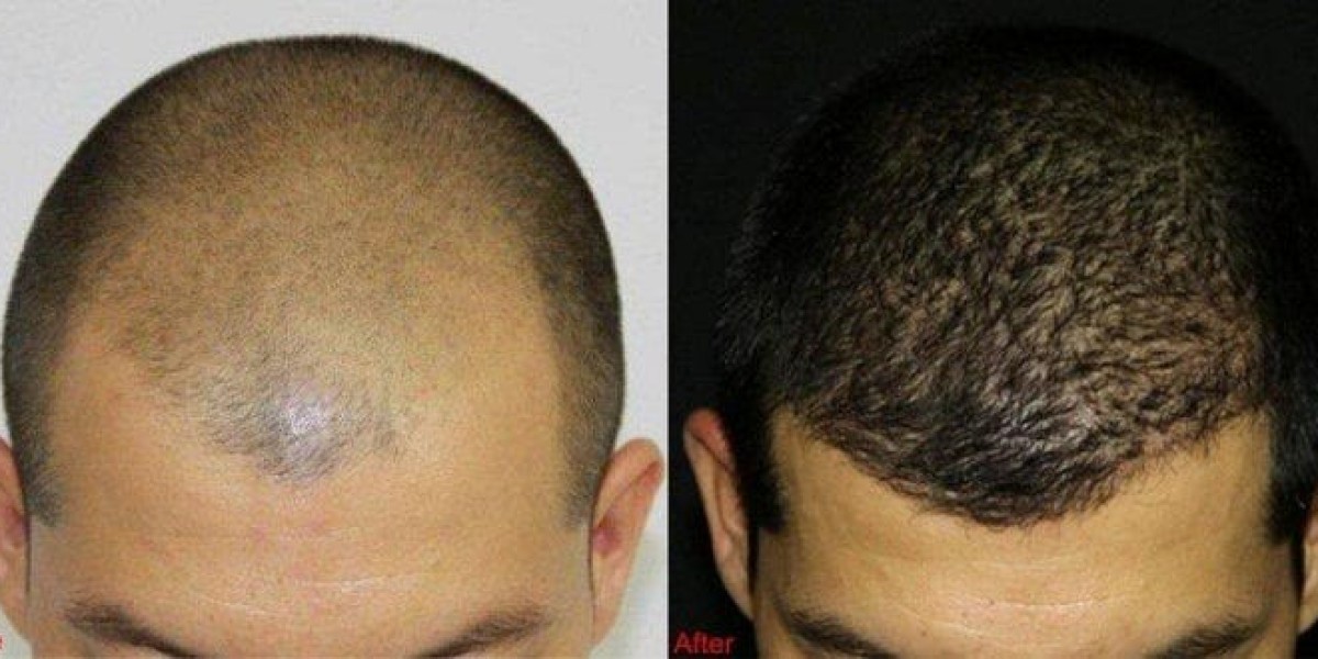 FUE Hair Transplant in Dubai: What You Need to Know