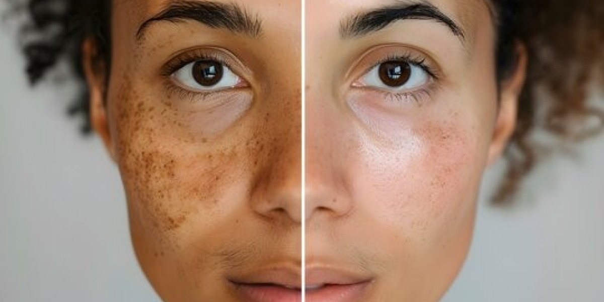 Skin Pigmentation in Dubai: Causes and Treatment Guide