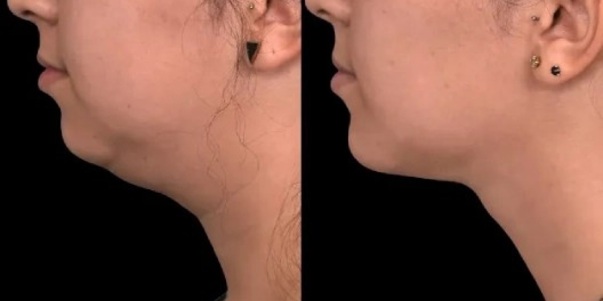 Double Chin Removal in Dubai and Modern Cosmetic Innovations