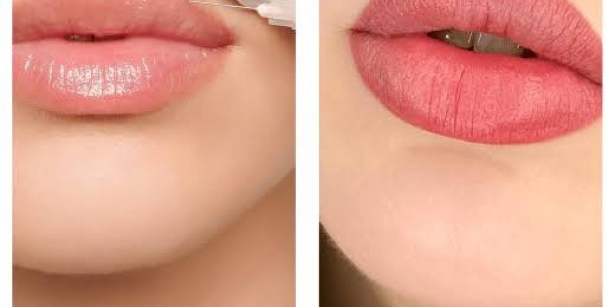 Russian Lip Fillers in Dubai for Balanced Facial Features | Complete Guide