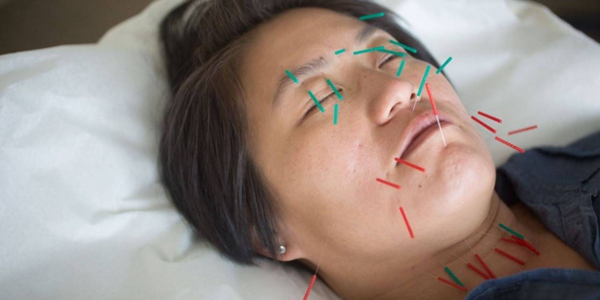 Facial Rejuvenation Acupuncture Before an Event: Timeline