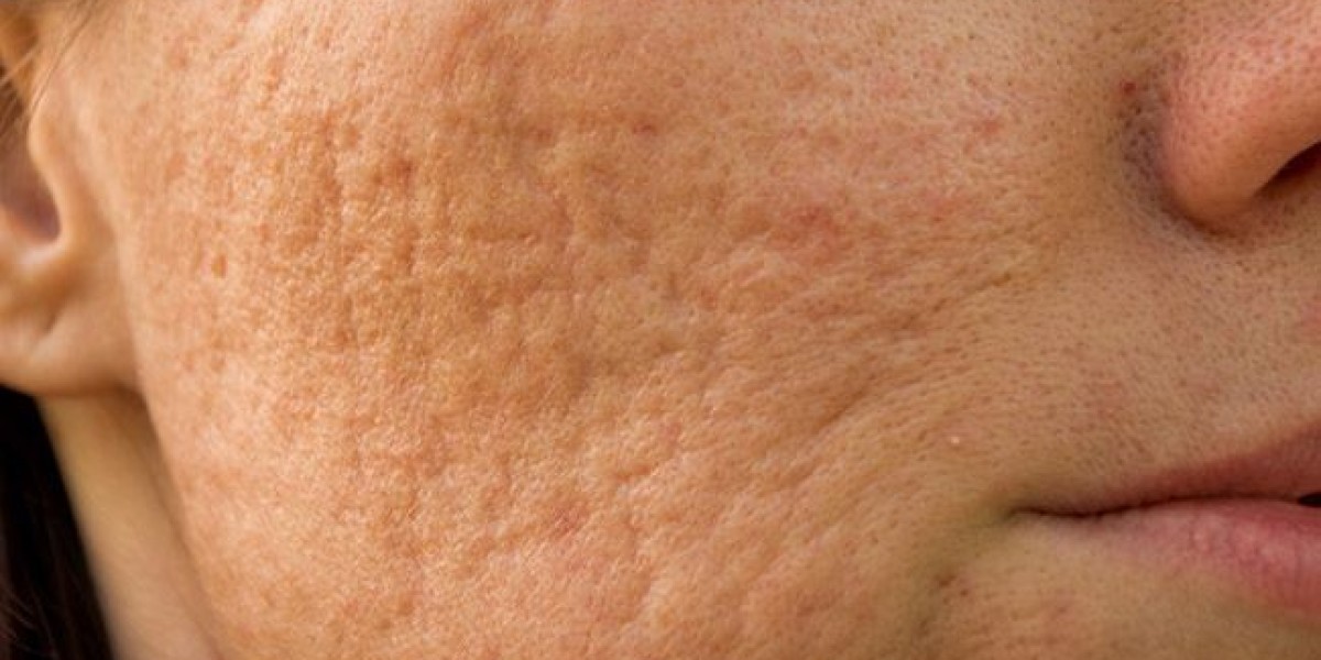 Acne scar treatment in dubai: Revitalize Your Complexion