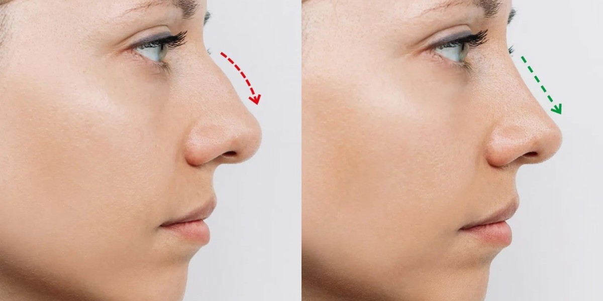 Rhinoplasty in Islamabad: The Modern Facial Engineering Approach to Nose Enhancement