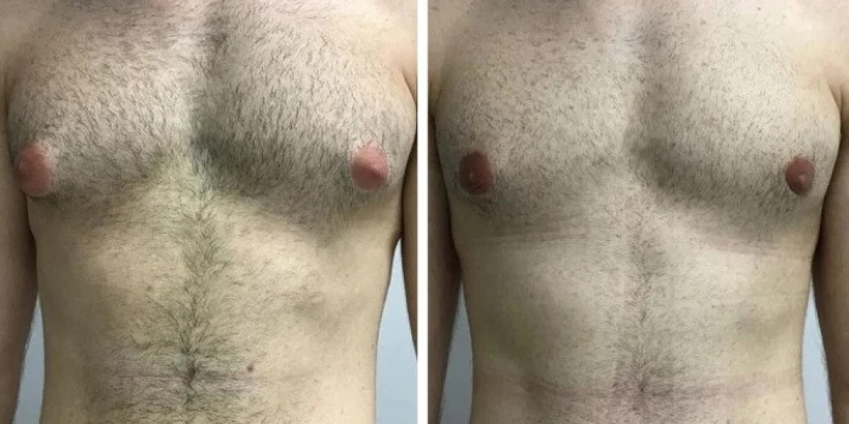 Latest Gynecomastia Surgery Advances According to Best Doctors in Dubai