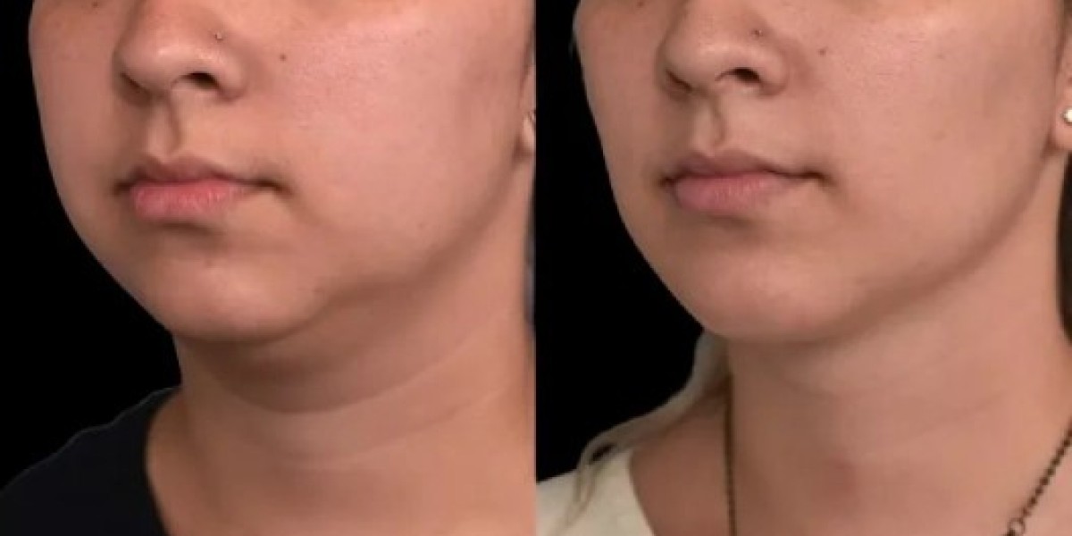 Double chin removal in Dubai Defined Features
