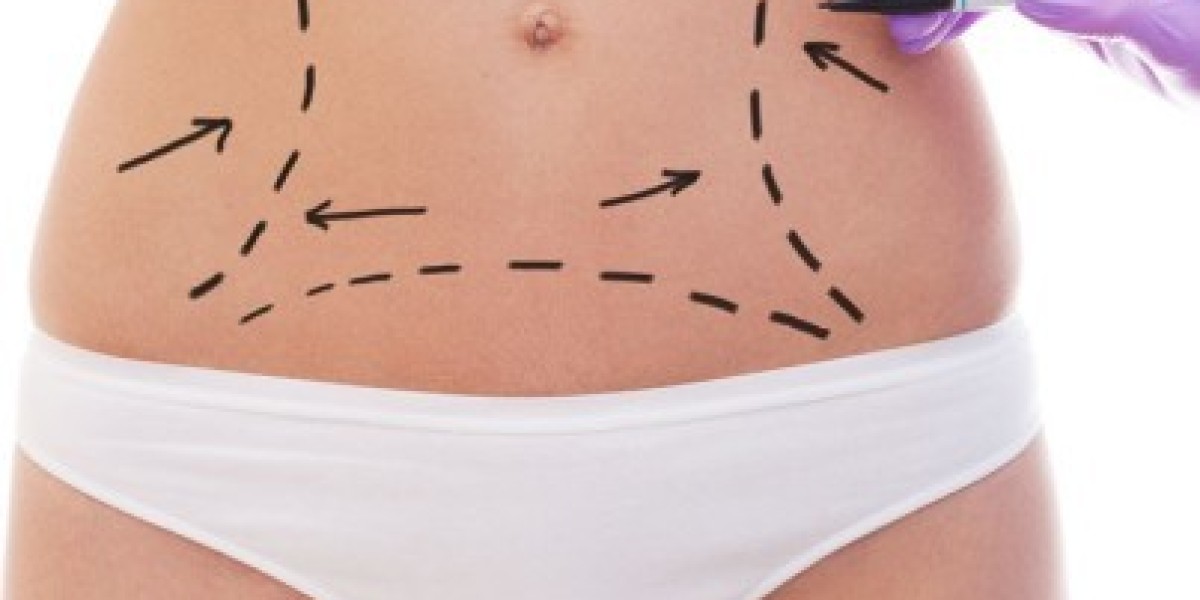 The Latest Advances in Liposuction in Pakistan You Should Know