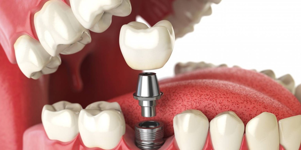 Dentist Near Me: Why Choosing Dental Implants Near Me Is the Best Solution for Missing Teeth