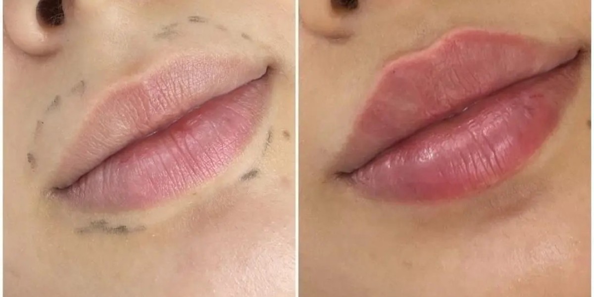 Juvederm Treatments in Dubai Treatment Insights