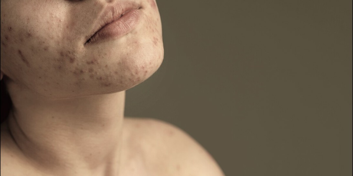 Acne Treatment: Get Clear, Healthy Skin with Expert Care